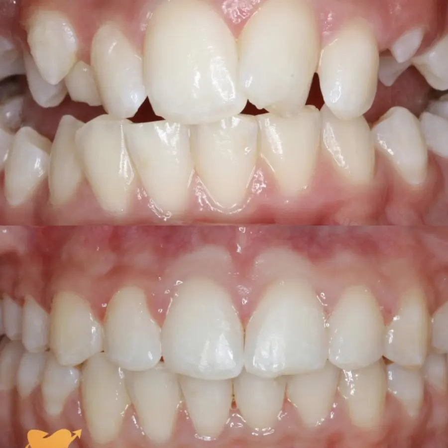 orthodontic jaw expansion example