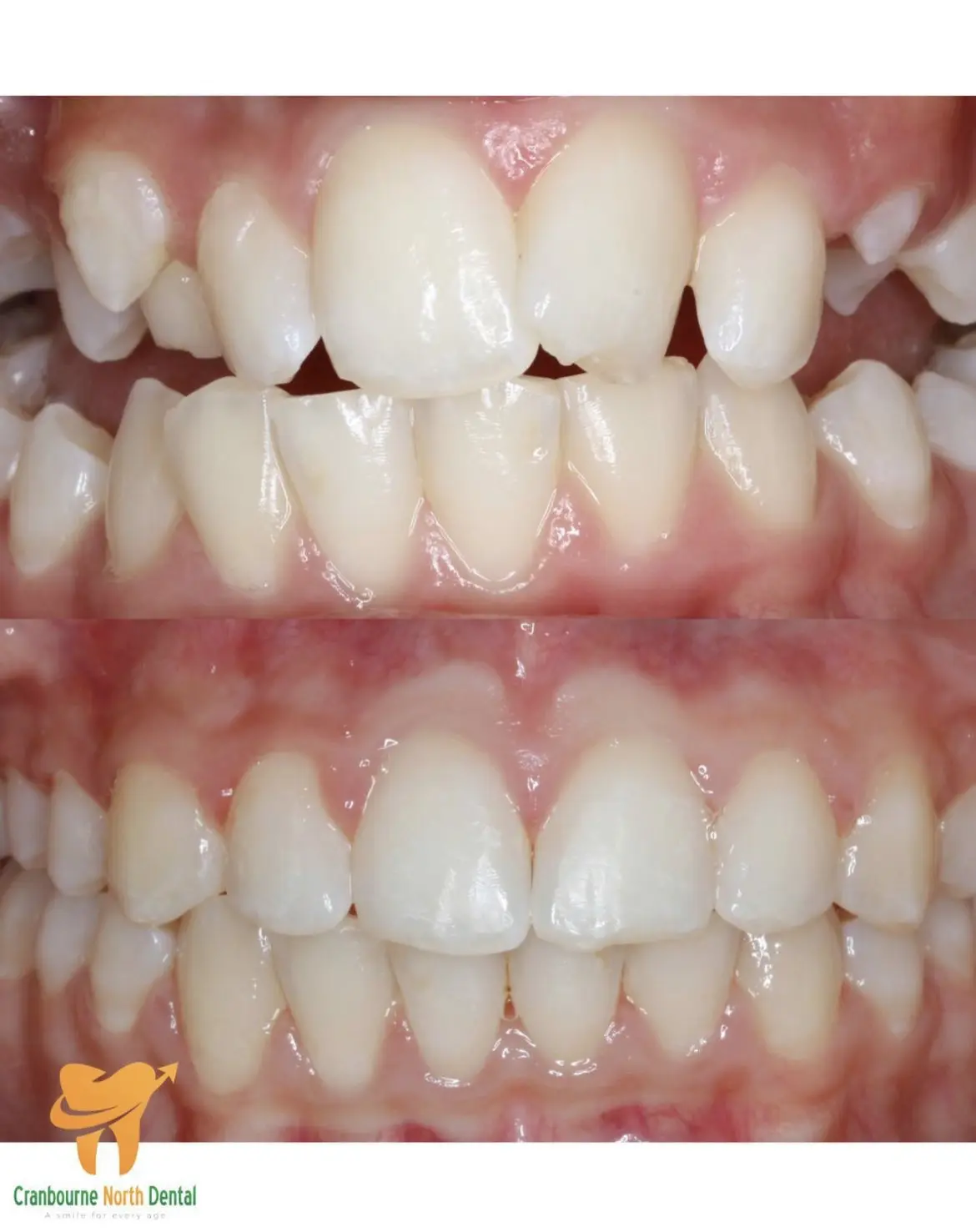 orthodontic jaw expansion example
