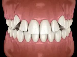 Impacted Incisors, Overcrowded Teeth. Medically Accurate 3d Illustration Of Abnormal Dental Occlusion