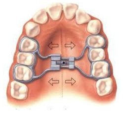 Maxillary Jaw Expansion