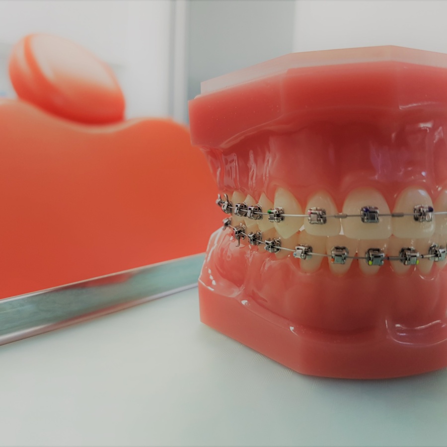 Braces Model