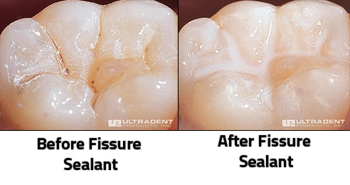 Fissure Sealant Example