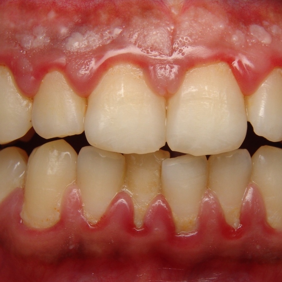 Gum Disease Blog