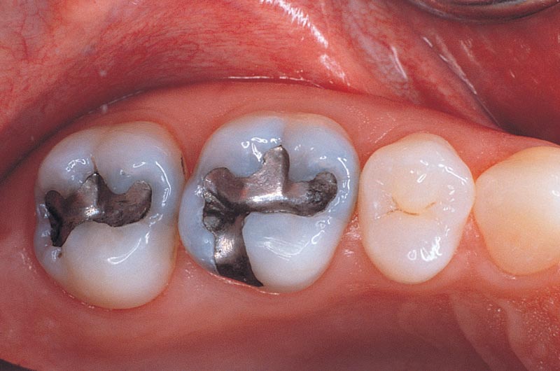 Amalgam Fillings Blog