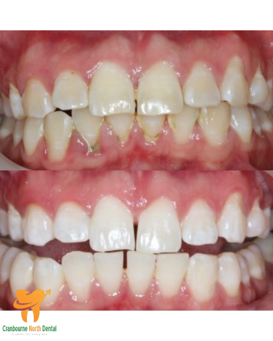 Teeth Whitening B/A
