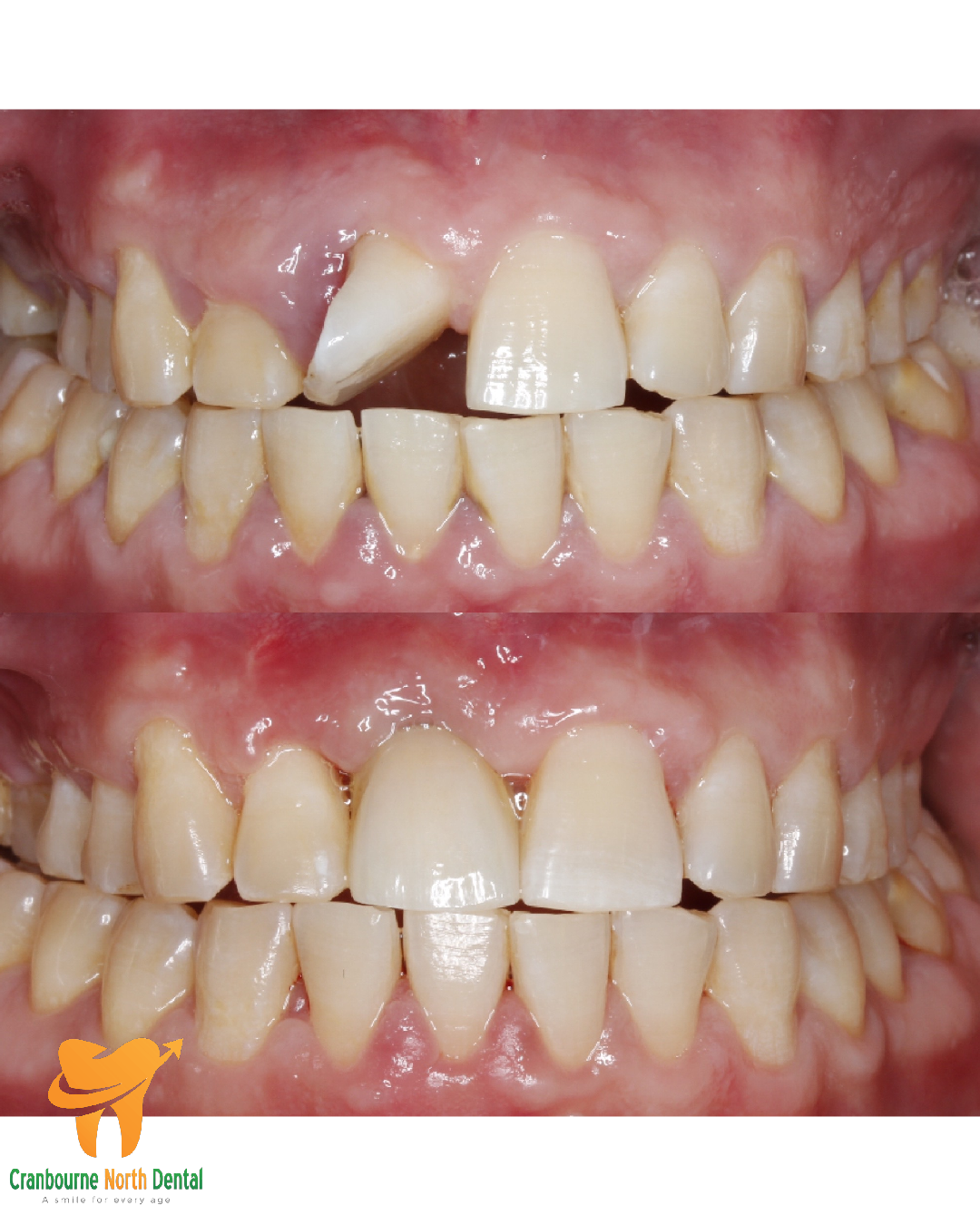 Dental Implant – Before & After
