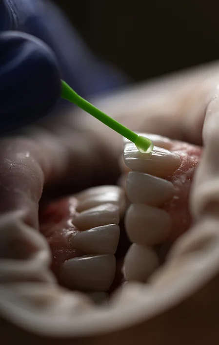 dental veneer application on a patient