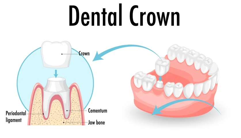 Dental Crown Diagram (small)