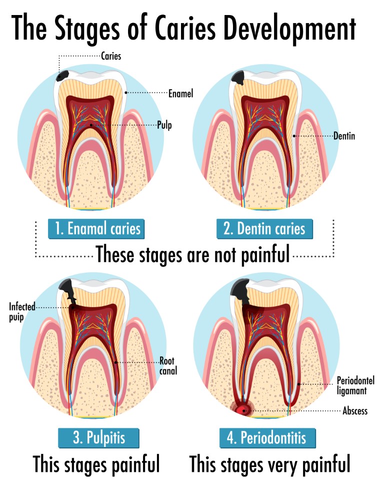Infographic Of Human In The Stages Of Caries Development