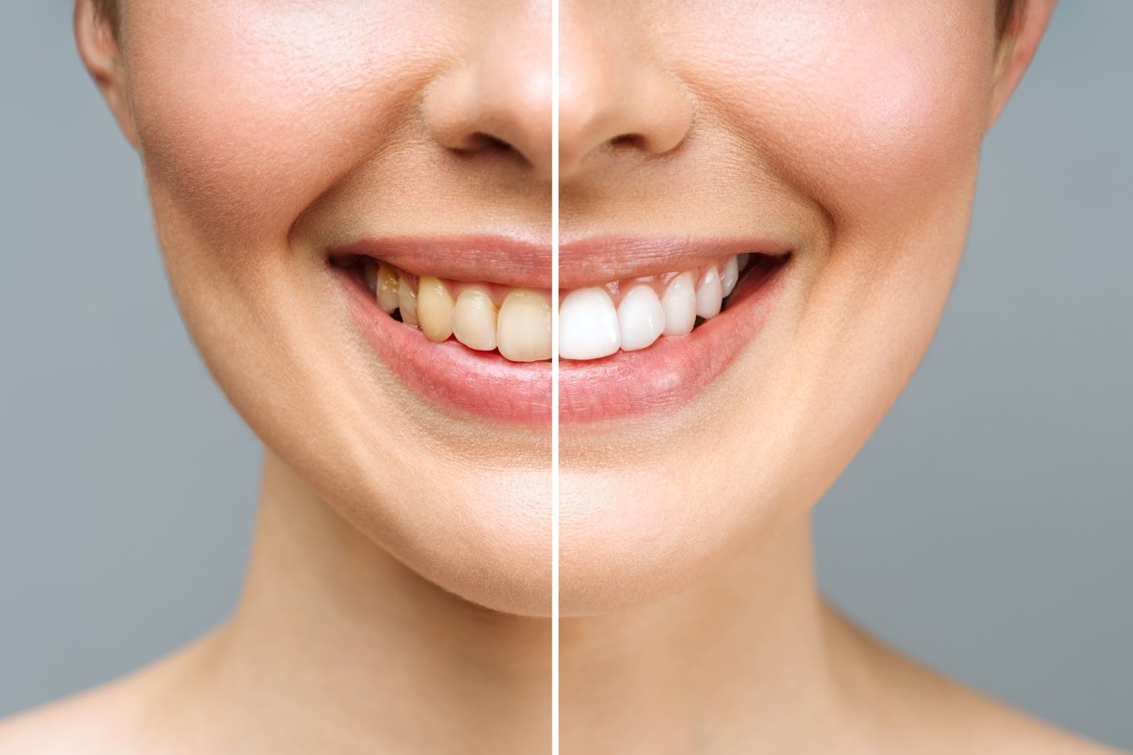 Woman Smiling Showing How To Whiten Teeth