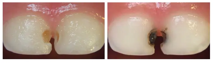 Silver Diamine Fluoride Staining On Teeth