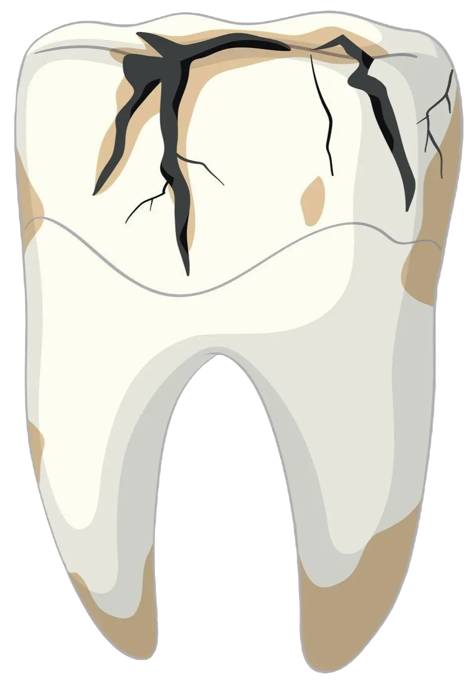 Cracked Tooth