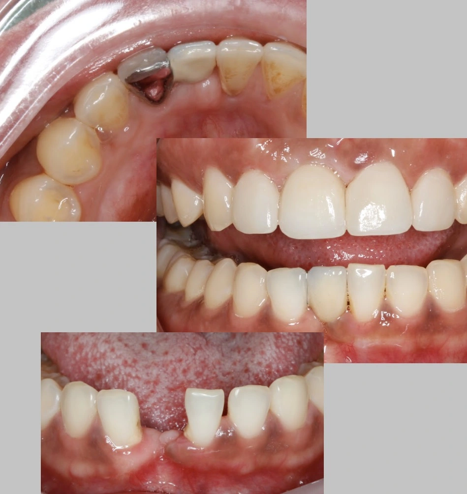 Dental Maryland Bridge Example Case