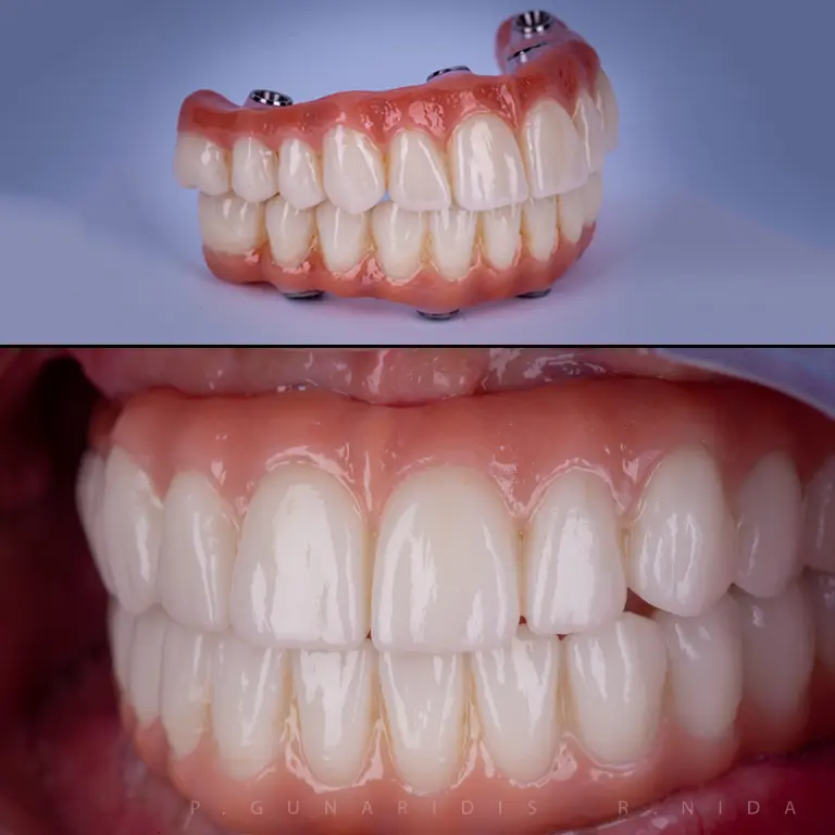 Full Mouth Dental Implants Example