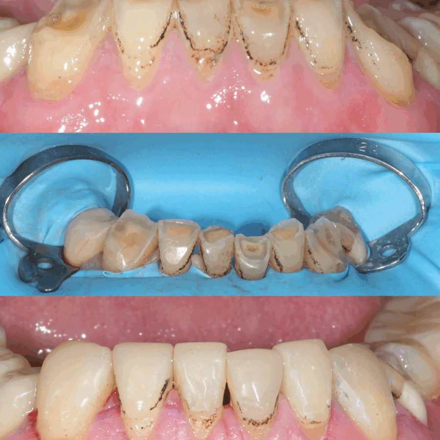 Composite Buildup