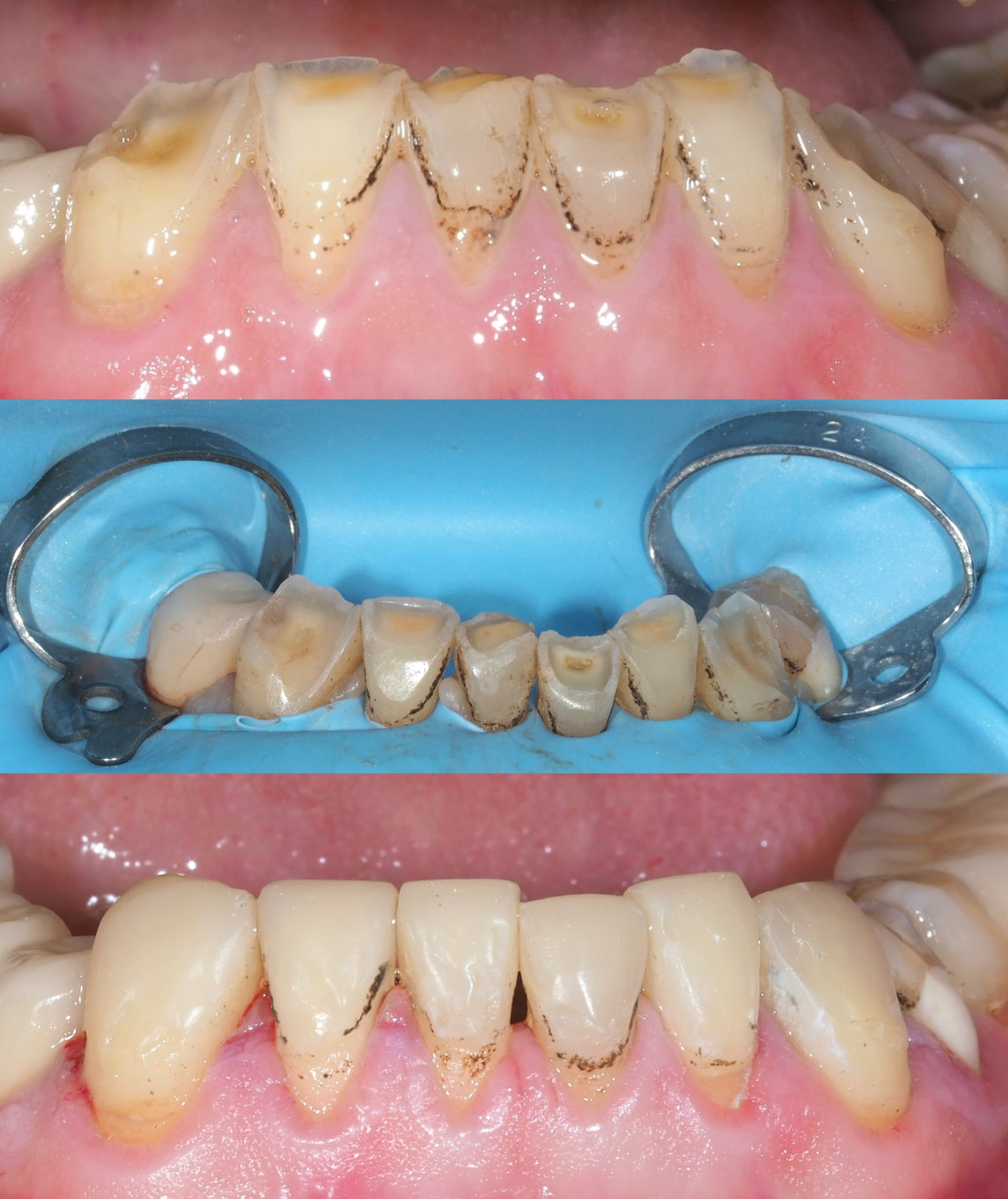 Composite Buildup