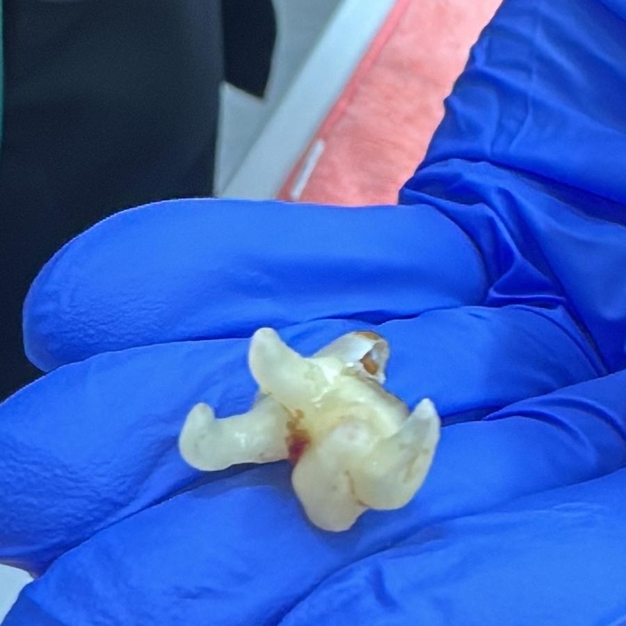 Extractedtooth