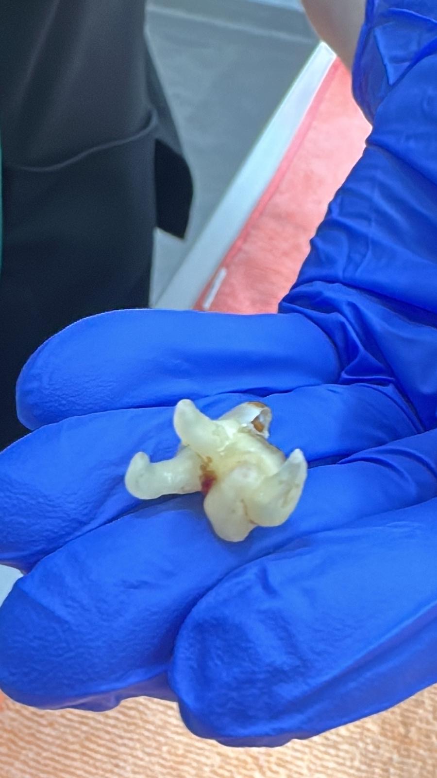 Extractedtooth