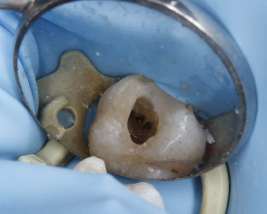 Inside The Tooth Canal