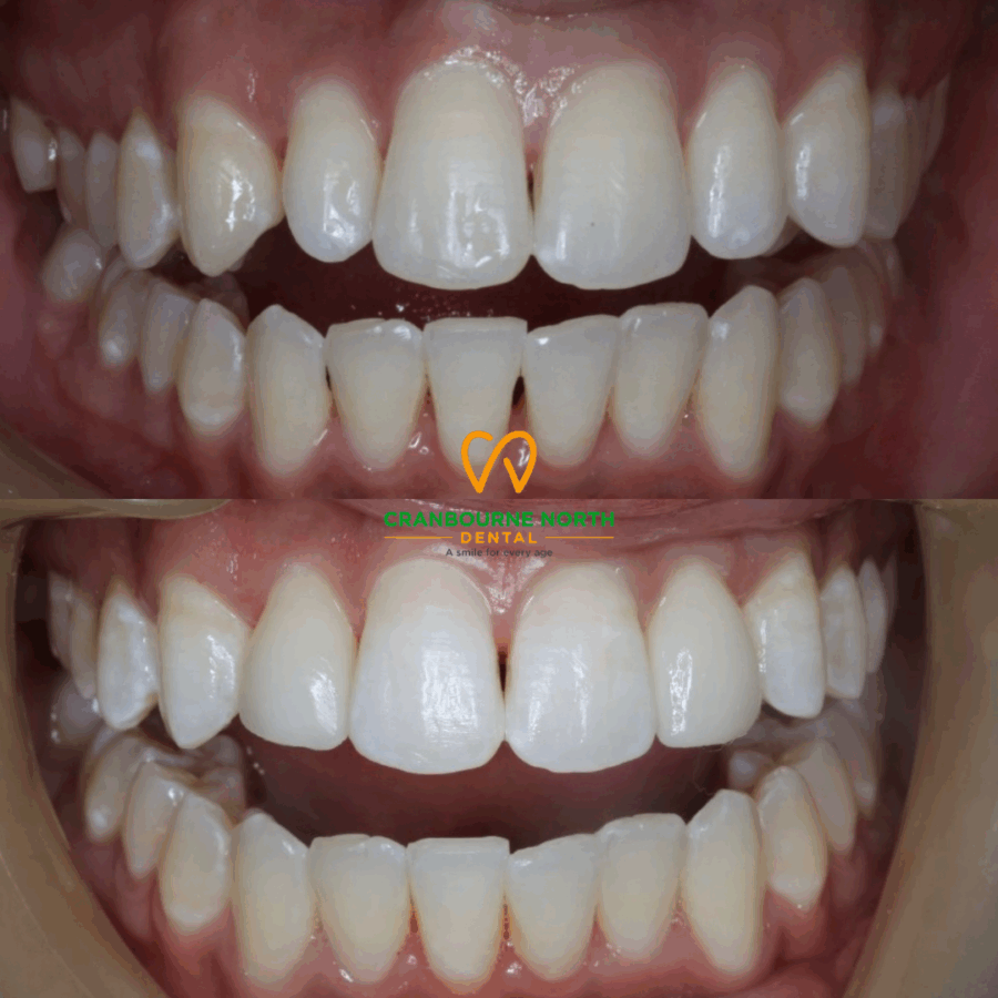 Upperlateralbeforeafter