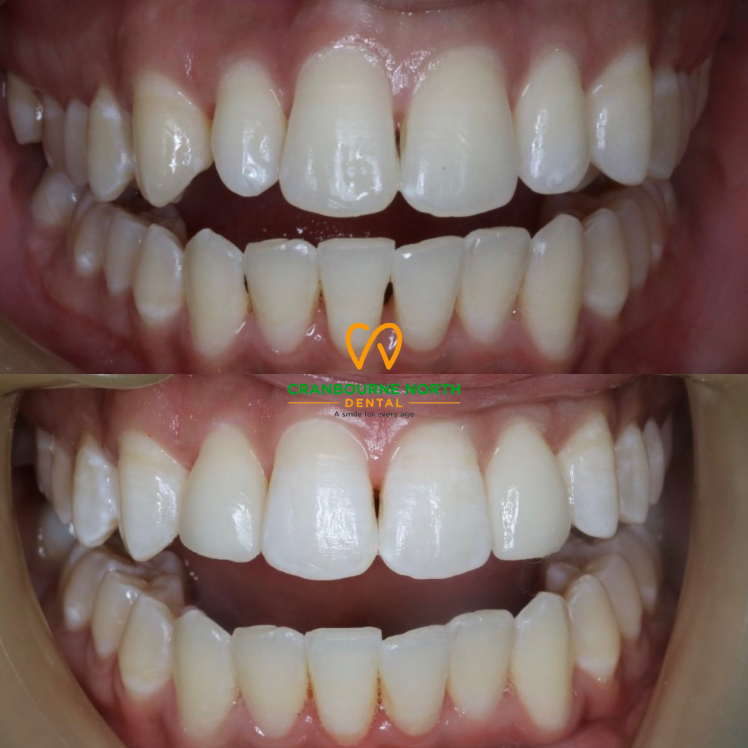 Upperlateralbeforeafter