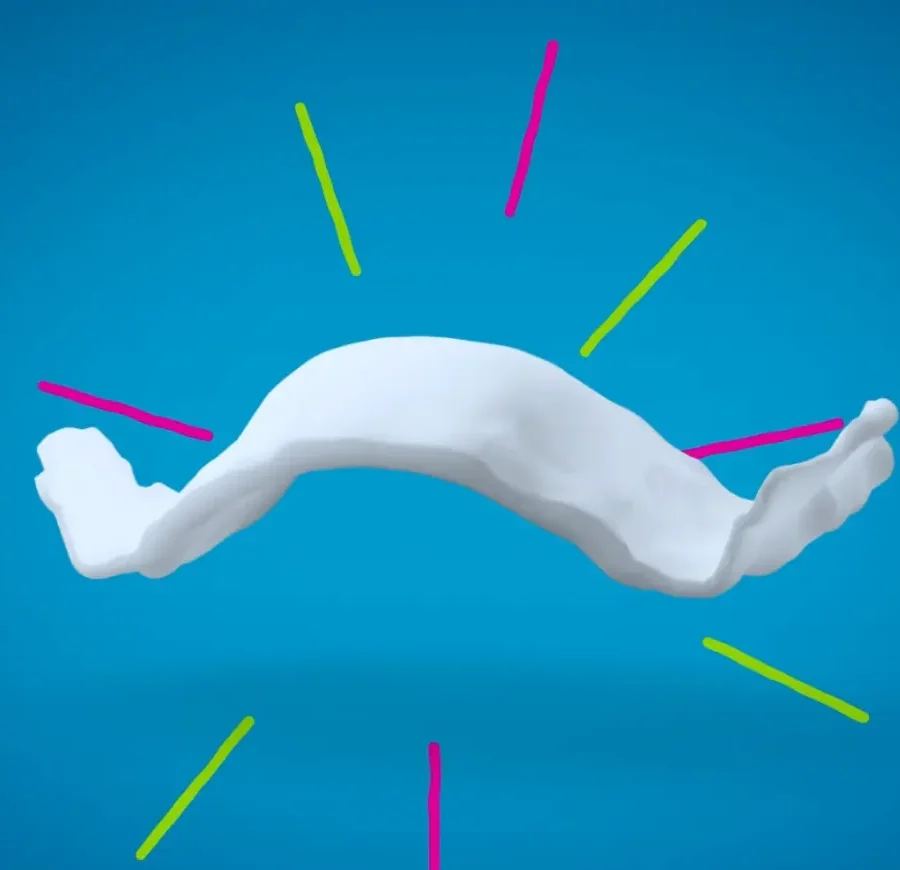 Invisalign Palatal Expander