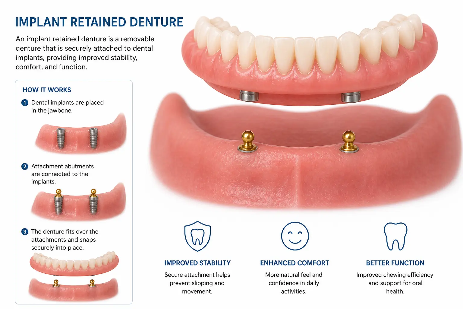 Implant Supported Overdenture Infogram
